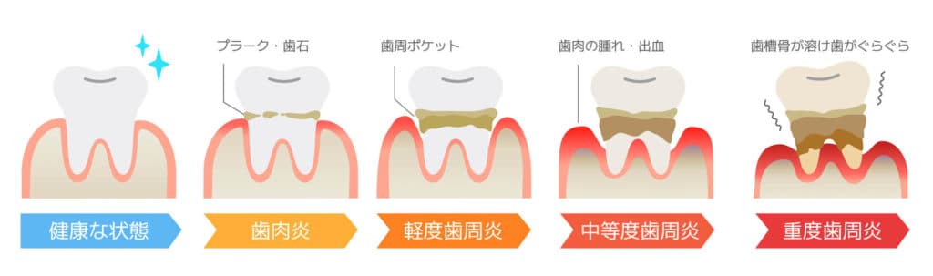 歯周病の概要の画像